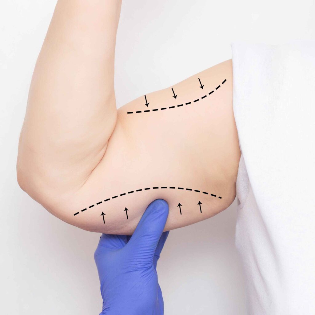 Achieve Toned and Youthful Arms with Arm Lift Surgery (Brachioplasty)